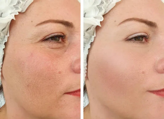 Before and after microneedling results showing smoother, rejuvenated skin