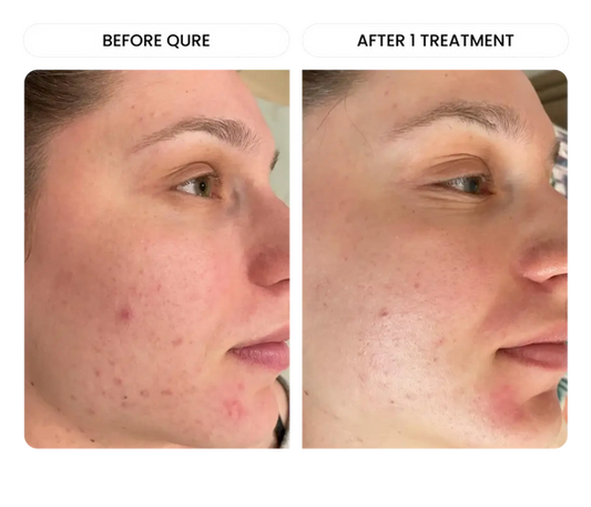 Woman using microneedling for acne scars at home with Petal