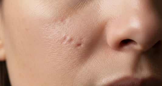 Microneedling myths about pitted scars explained with real skin texture