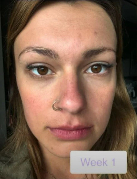 Before - Rachel